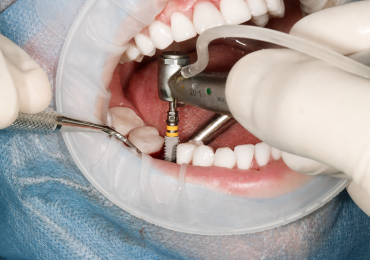 Implantes dentales