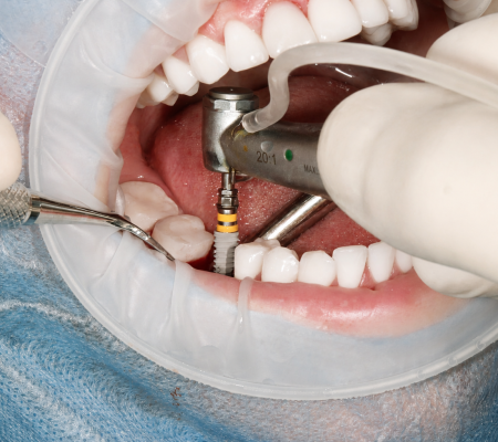 Implantes dentales