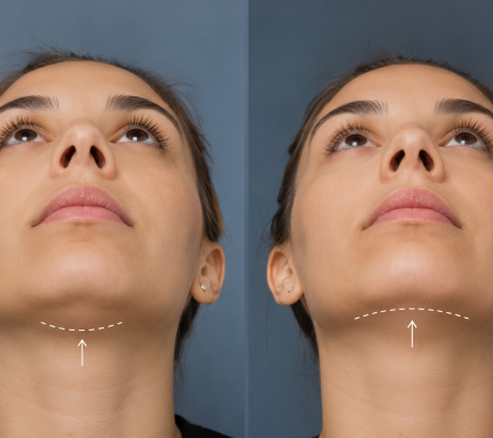 Mentoplastia